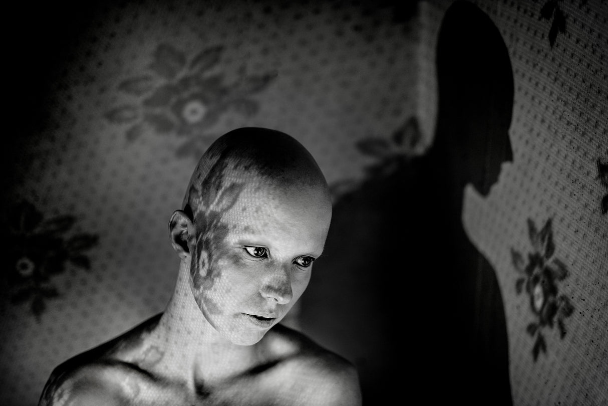 Alopecia Poster och Canvastavla