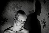 Alopecia Poster och Canvastavla